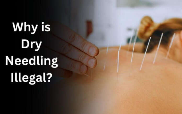 Why is Dry Needling Illegal